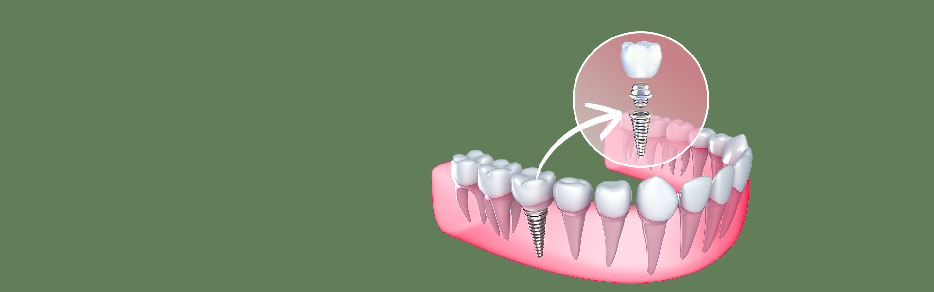 Dental Implants
