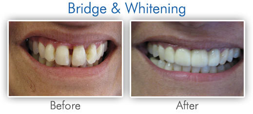Before & After Bridge & Whitening