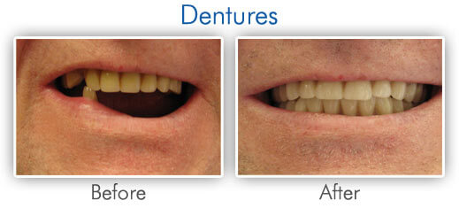 Before & After Dentures Treatment