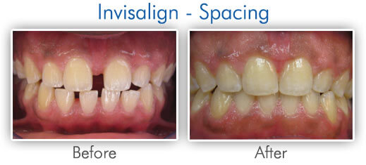 Before & After Invisalign Spacing Treatment