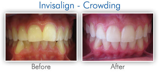 Before & After Invisalign Crowding Teeth