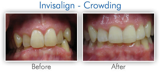 Before & After Invisalign Crowding