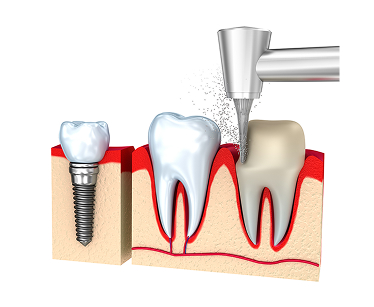 Top-Rated Dental Implants near you in Carrollwood