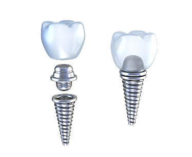 Top-Rated Dental Implants in Tampa, FL