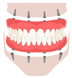 Types of Abutments of dental implants in Carrollwood