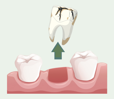 Dental Implants near me in tampa