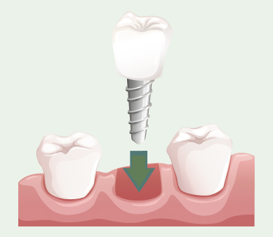 What Dental Implants Can Do for You