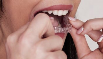 Top 7 Reasons Tampa Residents Are Choosing Invisalign Over Braces
