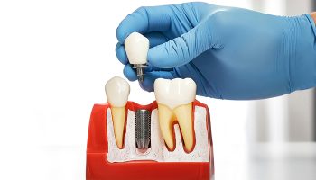 Dental Implants in Tampa: What You Need to Know Before You Book