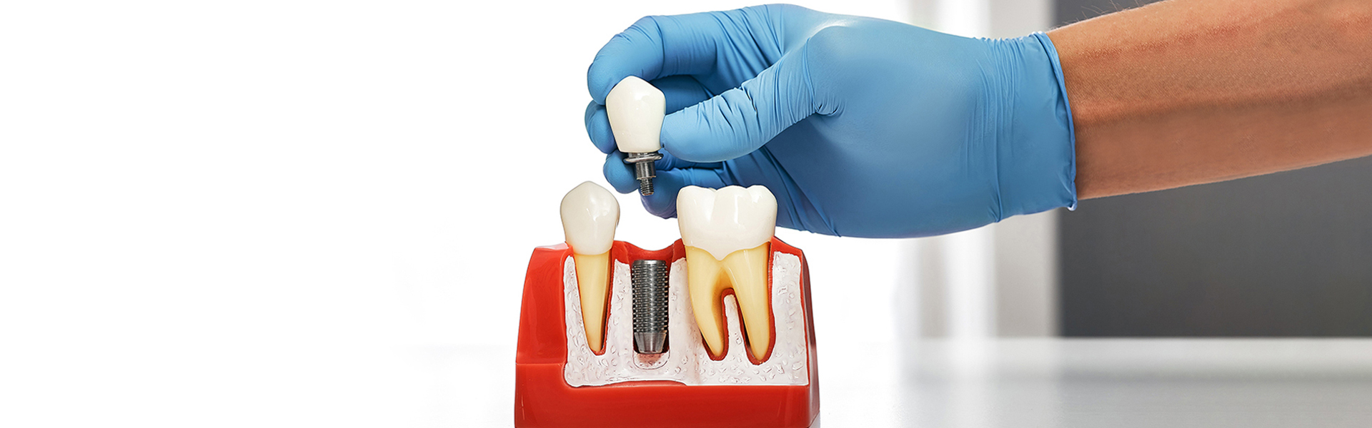Dental Implants in Tampa: What You Need to Know Before You Book