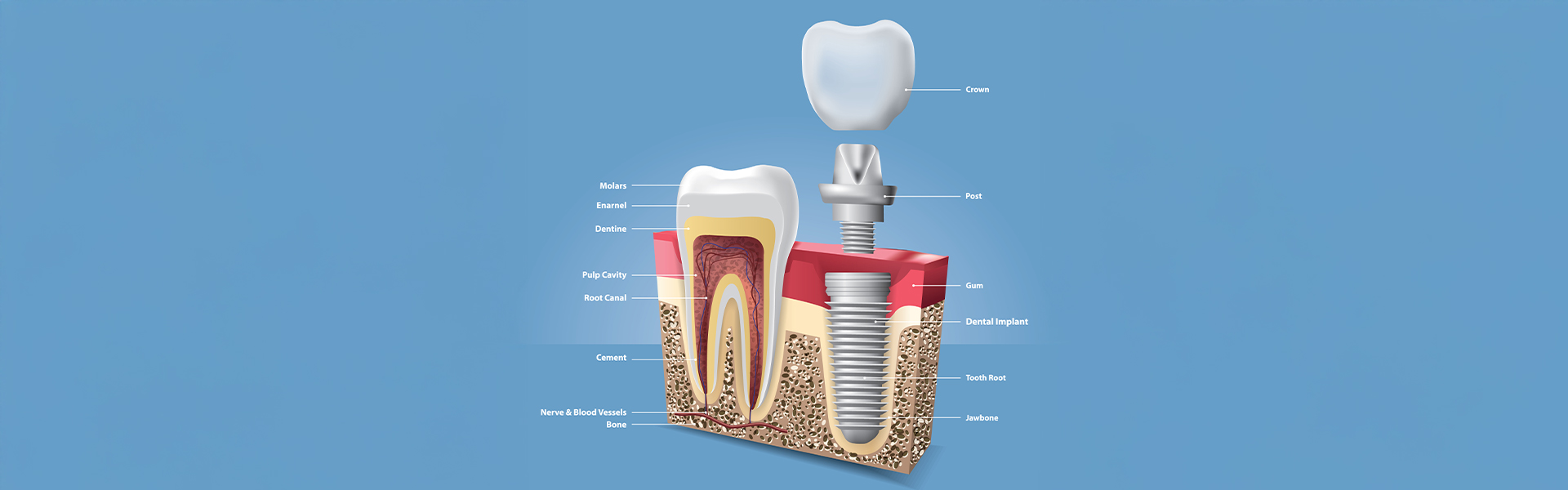 Affordable Dental Implants in Carrollwood, FL: What You Need to Know