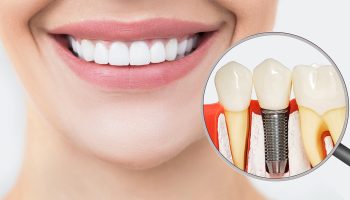 Where Can I Find Affordable Dental Implants in Tampa, FL?